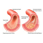 Атеросклероз